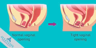 Side-by-side comparison of a normal vagina and a vagina affected by vaginismus, illustrating muscle tightening and discomfort