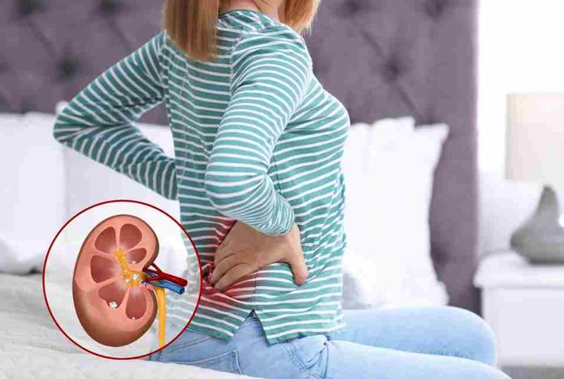 Kidney stones | Causes, symptoms, and laser treatment for kidney stones