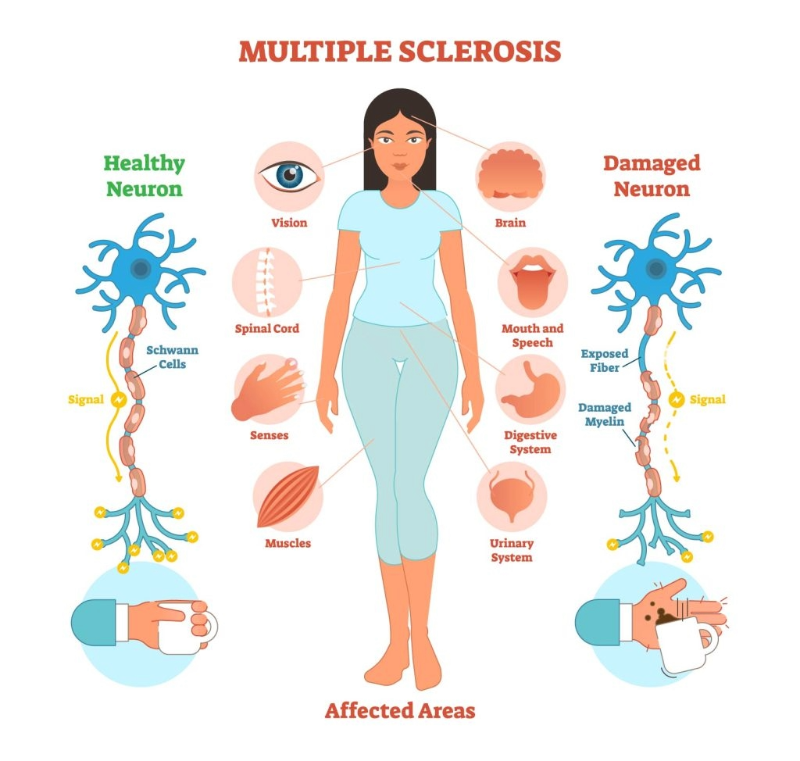 Medical illustration showing a human nervous system with demyelinated areas on the brain and spinal cord, highlighting the nerve damage caused by multiple sclerosis