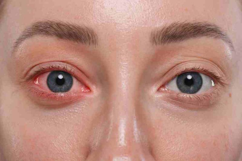 Close-up of an eye that is red and inflamed, showing symptoms of eye irritation and discomfort.