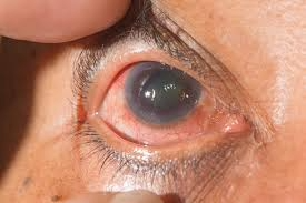 Close-up of a human eye showing signs of glaucoma, highlighting increased intraocular pressure and optic nerve damage.