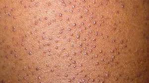 Close-up photo of keratosis pilaris (chicken skin) on the upper arm, showing small red and rough bumps caused by clogged hair follicles