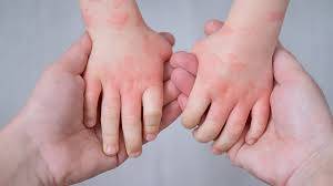 A mother gently holding her baby’s hand showing visible signs of eczema, highlighting skin irritation and care