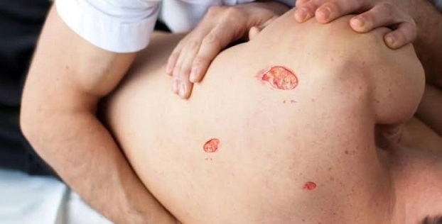 Elderly patient with a bedsore on the lower back showing red inflamed skin