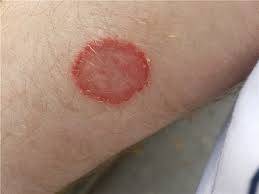 Close-up photo of a skin patch affected by tinea (ringworm), showing red, circular, scaly rash with a raised edge and clear center on the skin