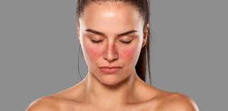 Woman with lupus showing butterfly-shaped rash across cheeks and nose