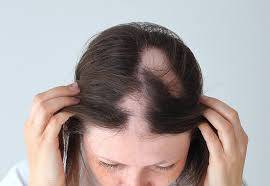 A young woman with alopecia showing visible bald patches on her scalp, highlighting sudden patchy hair loss