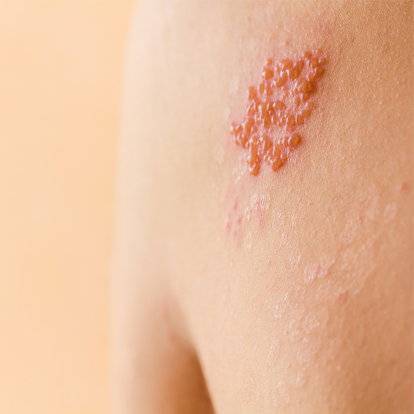 Close-up of shingles rash showing red, blistering patches on the skin in a stripe-like pattern