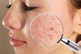 Close-up of a woman’s face with acne spots, examined under a magnifying glass