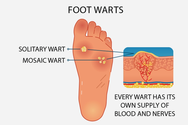Close-up photo of a plantar wart on the sole of the foot, showing a small rough skin growth with tiny black dots