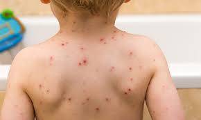 A baby with chickenpox showing red, itchy spots and fluid-filled blisters on the back