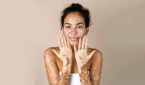 Close-up photo of a female’s hand and face with white patches caused by vitiligo, showing loss of skin pigment and clear contrast with natural skin tone."