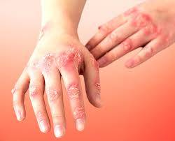 Hand with psoriasis displaying dry, cracked skin