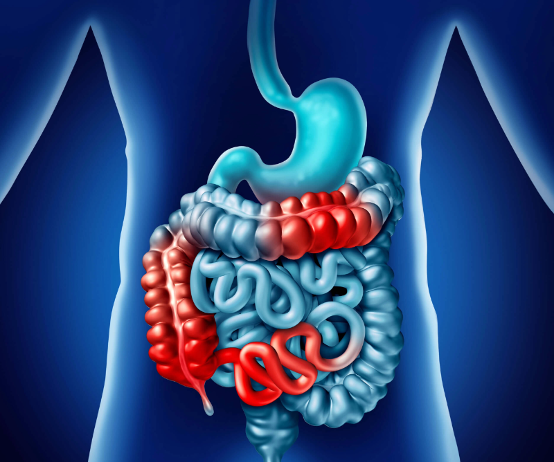 Close-up of a human abdomen showing inflammation and pain associated with Crohn’s disease, highlighting the digestive tract area commonly affected