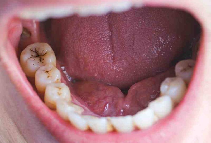Image showing the stages of tooth decay, from healthy enamel to deep cavities, with a comparison between a decayed tooth and a healthy one
