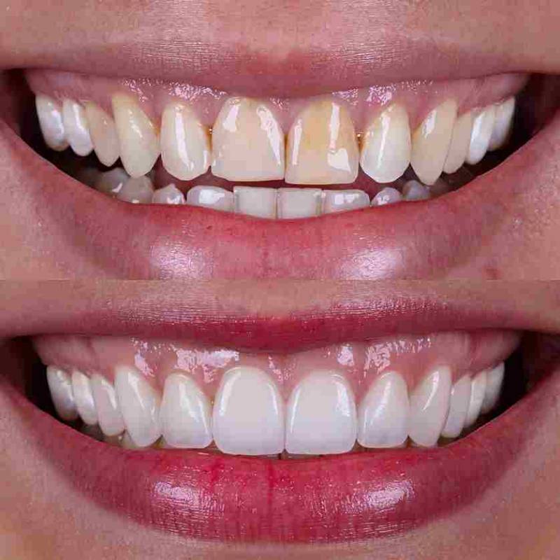 Before and after photo showing teeth color improvement — the “before” image displays yellow, stained teeth, while the “after” image shows bright, white, and clean teeth after whitening treatment