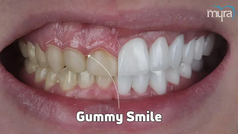 Before and after photo showing a patient’s smile — the “before” image displays a gummy smile with excessive gum showing, while the “after” image shows a balanced, aesthetically pleasing smile after treatment