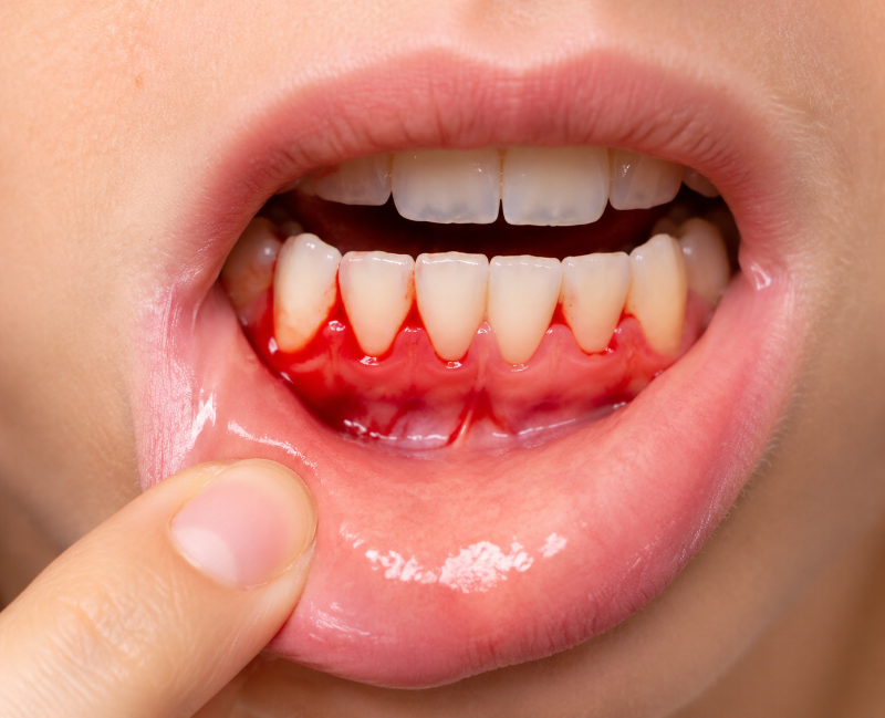 What causes bleeding gums, and could it be a sign of a serious condition?