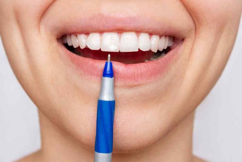 Photo showing teeth with white spots before and after treatment, highlighting the difference between damaged enamel and the smooth, shiny surface after removal