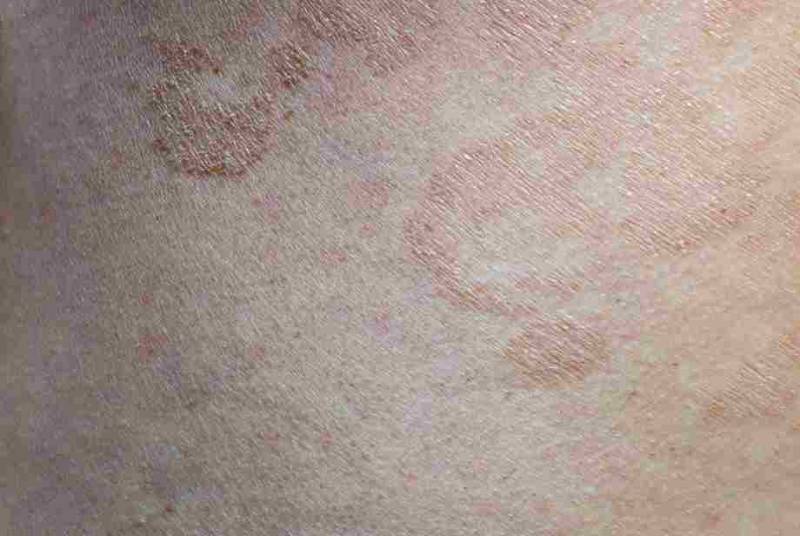 Close-up image of skin showing small, discolored patches typical of white tinea (tinea versicolor), highlighting the affected areas with slight scaling