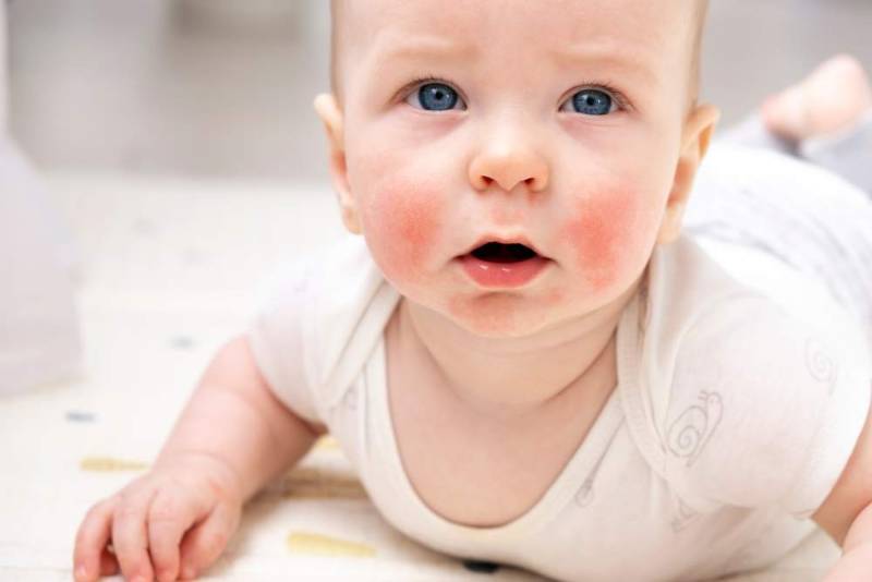 Close-up of a baby’s face showing red, irritated, and dry patches typical of atopic dermatitis (eczema), highlighting common areas affected in infants.