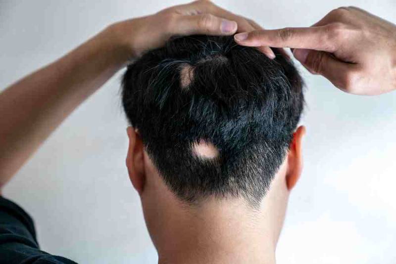 Alopecia areata showing circular bald patches on the scalp