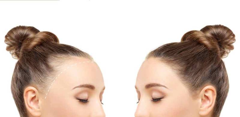 ide-by-side illustration showing hereditary hair loss in men and women, with before and after images demonstrating hair restoration treatments and improved hair density