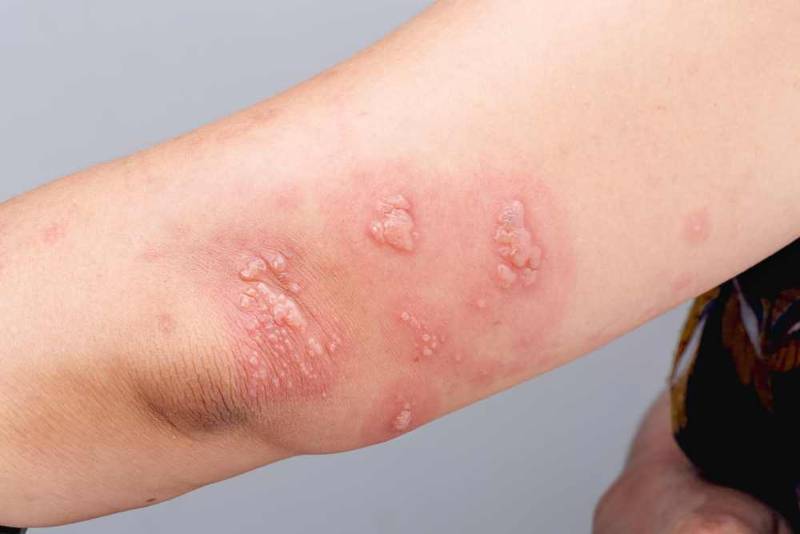 Close-up of a person’s torso showing a painful, blistering rash typical of shingles.