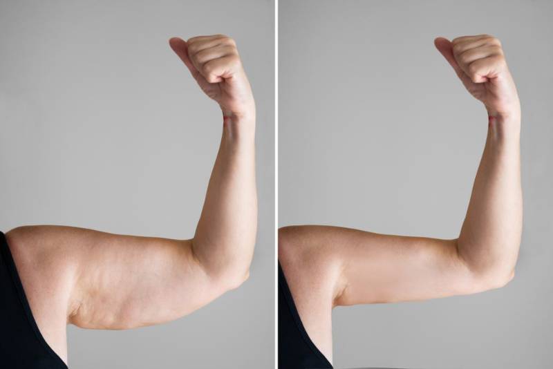 Side-by-side comparison of a woman’s upper arm before and after treatment, showing dimpled skin with cellulite on the left and smooth, firm skin on the right.