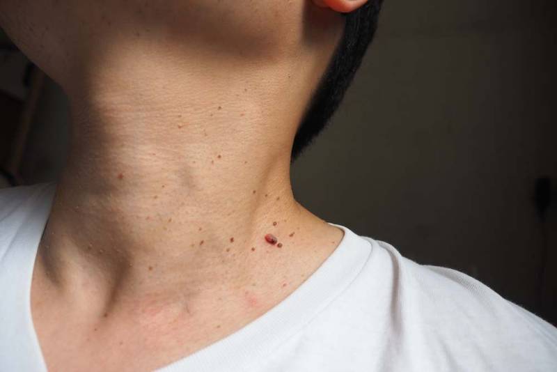 What are the causes of skin tags and how can they be removed?