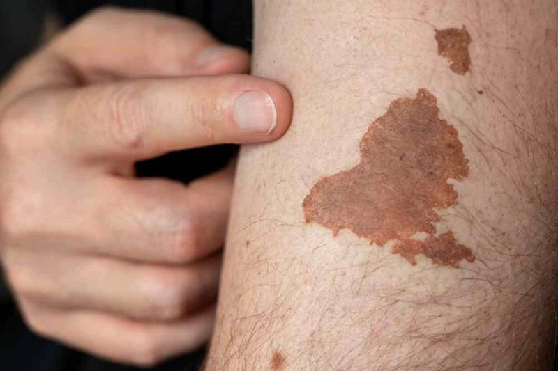 Close-up image showing a skin lesion with irregular borders and discoloration, illustrating one of the common types of skin cancer on the arm
