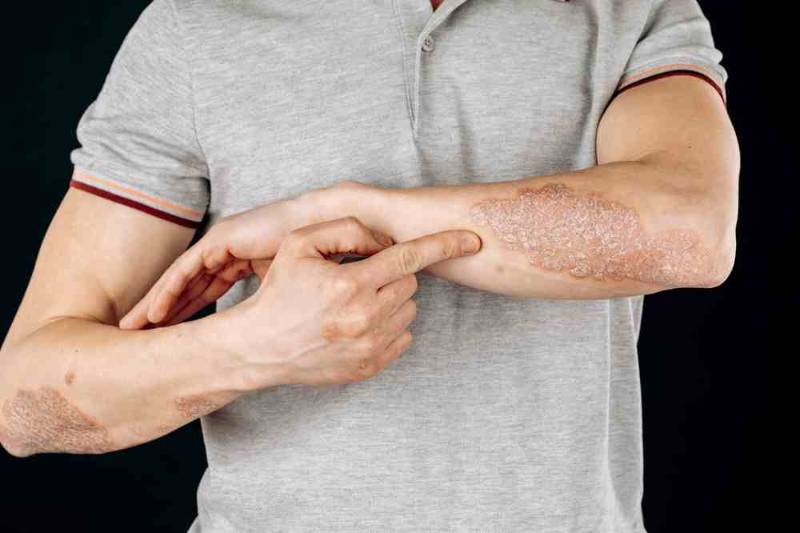 هل الصدفية معدية؟ أسباب الصدفية وعلاجها