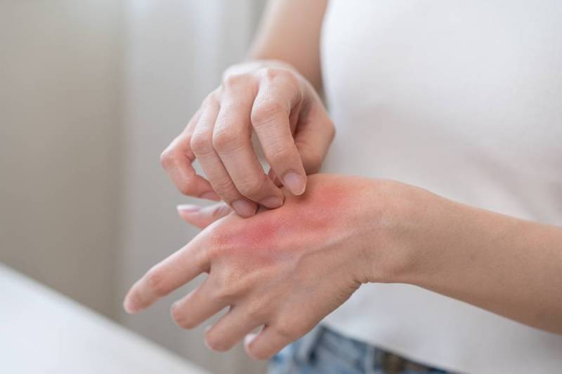 Close-up image of an irritated skin rash with red patches.
