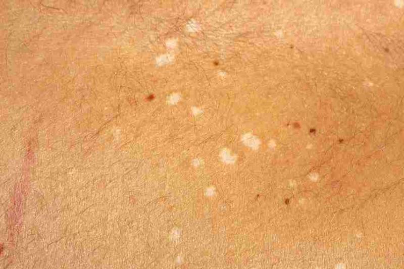 Close-up illustration of a skin patch with a circular red, scaly rash typical of tinea infection (ringworm), showing the inflamed edges and central clearing