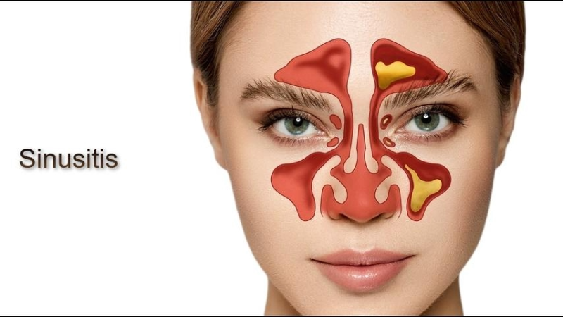Illustration showing inflamed sinus cavities causing pain and congestion