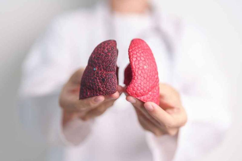 Side-by-side illustration of healthy lung tissue versus pulmonary fibrosis with thickened, scarred alveoli