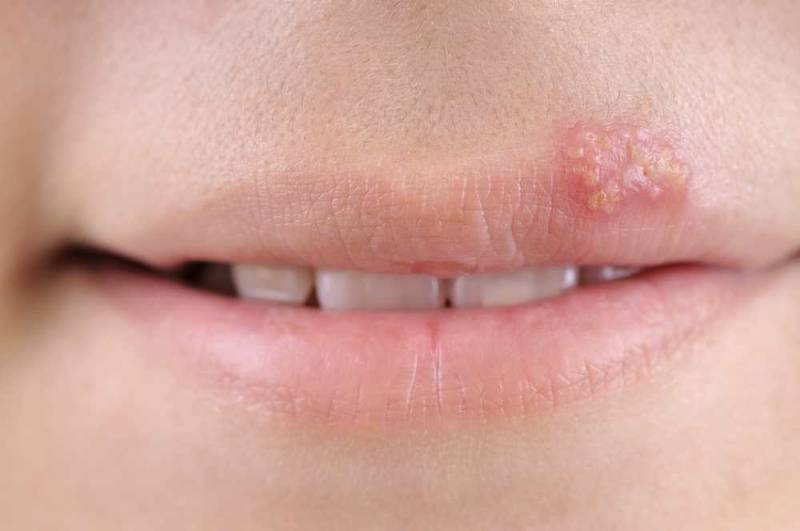 Close-up of lips showing cold sores caused by oral herpes.