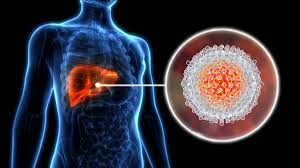 Illustration of the Hepatitis C virus affecting the liver, showing inflammation and highlighting the impact on liver health.
