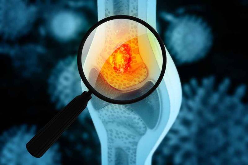 Bone Cancer | Causes, Types, and Treatment Methods | Vezeeta