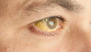 What Are the Symptoms of Pancreatic Cancer? Can It Be Cured?