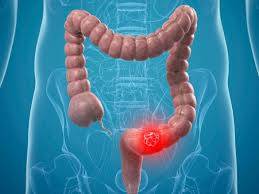 Is colon cancer fatal? A comprehensive guide to symptoms and survival rates