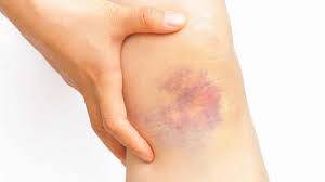 Leukemia Symptoms and Early Detection