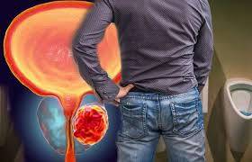 What are the early symptoms of prostate cancer?
