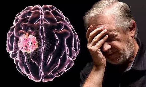 Brain Tumor Symptoms: When Is a Headache a Real Warning Sign?