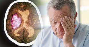 How to identify stroke symptoms and save someone's life in minutes