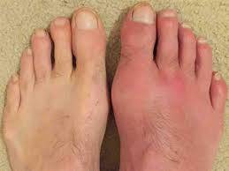 Sudden toe pain? Learn gout symptoms and treatment