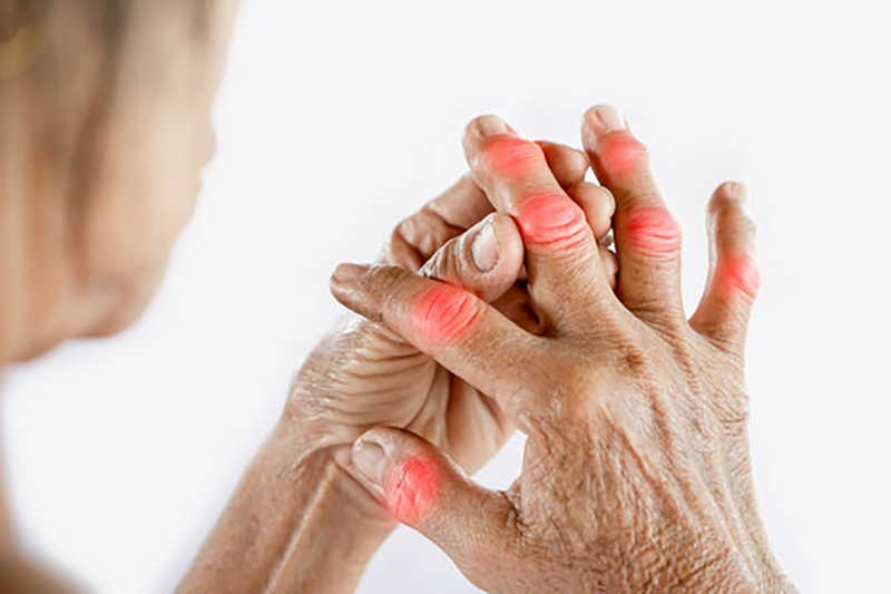 Hands affected by rheumatoid arthritis showing swelling and stiffness.