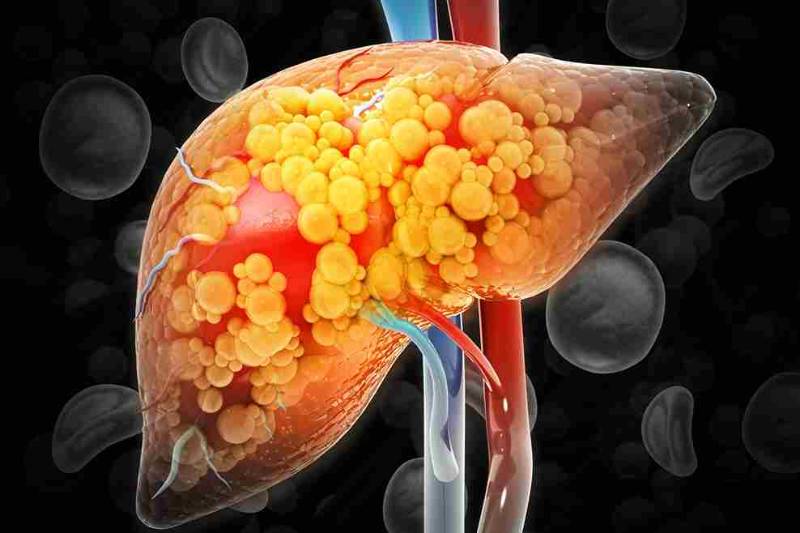 Close-up medical illustration of fatty liver showing abnormal fat accumulation within liver cells, highlighting tissue damage and inflammation