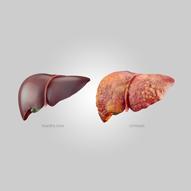 Comparison of a healthy liver and a cirrhotic liver, showing normal smooth texture versus scarred, nodular appearance caused by cirrhosis