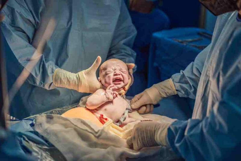 Surgeon performing a cesarean section (C-section) operation in a sterile operating room, delivering a newborn baby through an abdominal incision